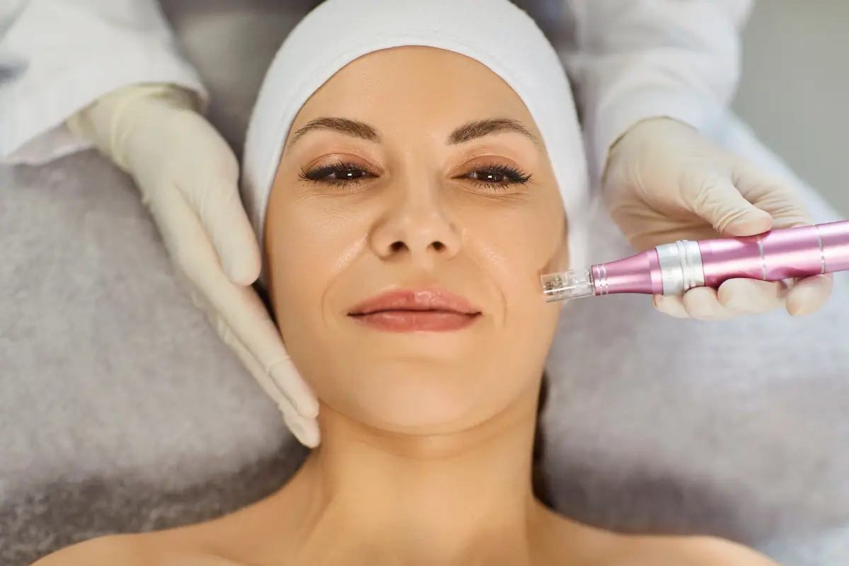 Microagulhamento facial